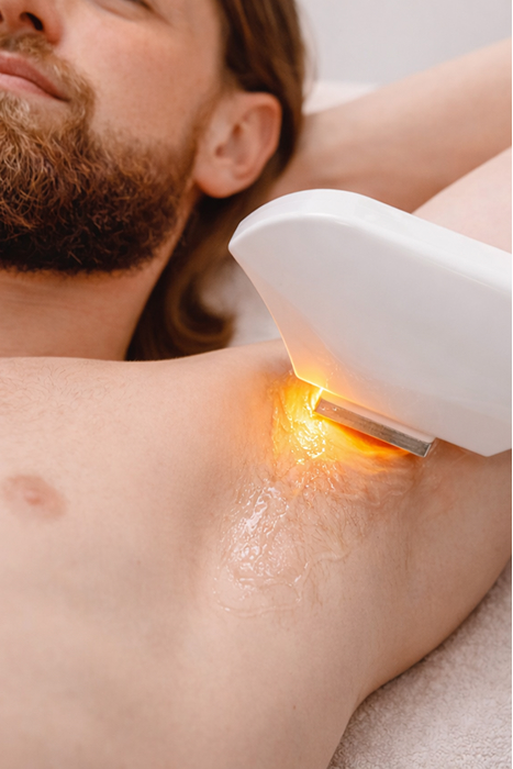 Laser Hair Removal Men
