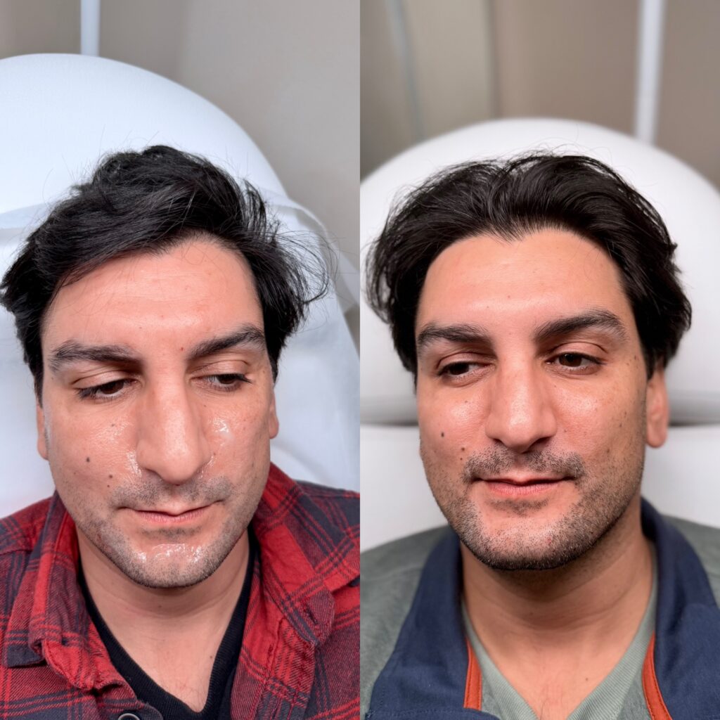 Radiesse (jawlines & cheeks)