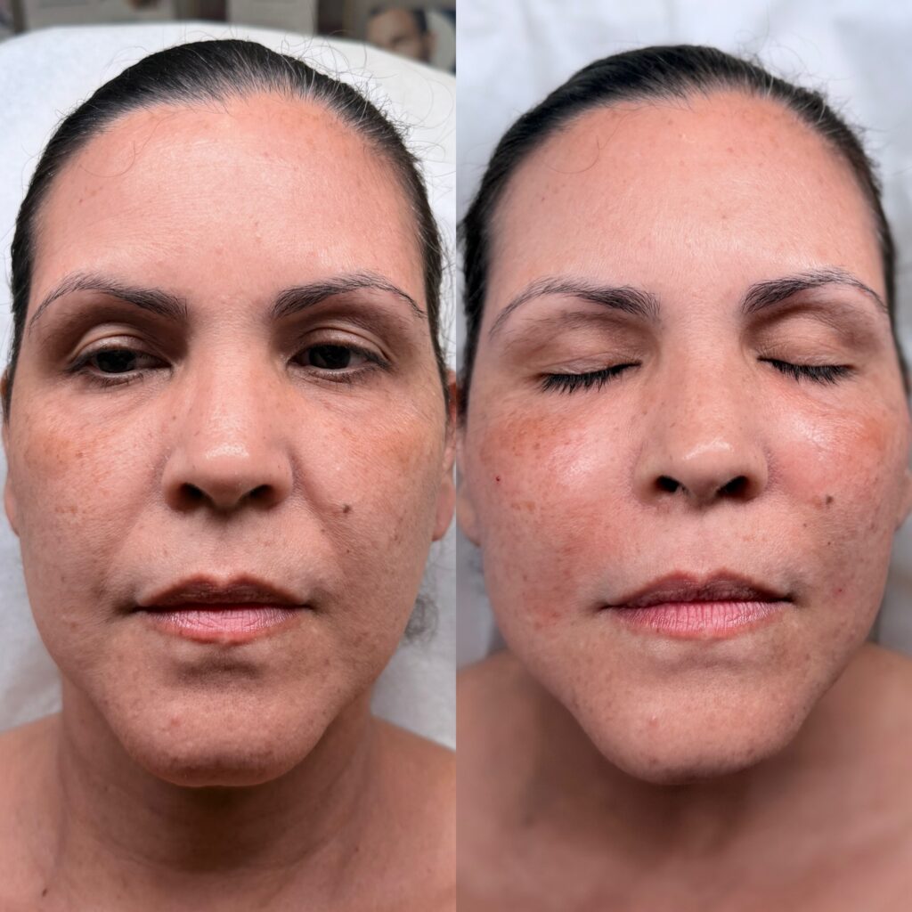 PRF EZ GEL (Undereyes & Nasolabial folds)